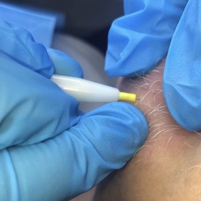 Epilation éléctrique